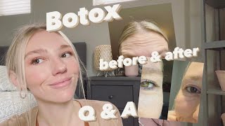 botox before and after  questions prices how many units [upl. by Ydal]