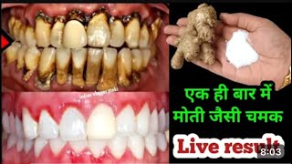 Teeth whitening at home in 2 minutes  How to naturally whiten your yellow teeth Il100 effective [upl. by Erodroeht759]