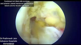 acl and lm root tear repair together [upl. by Adel404]