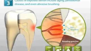 Demineralized Tooth Enamel Dynamics of Treatment [upl. by Nadaha]