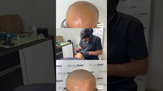 Scalp Micropigmentation Benefits Side Effects Before amp After Pics by Dr Varun Nambiar [upl. by Brigg882]