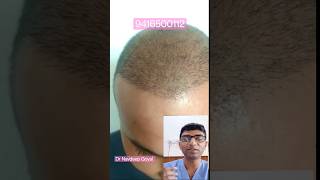 Shedding phase after hair transplant Dr Navdeep Goyal hair transplant clinic Panipat [upl. by Lanna457]