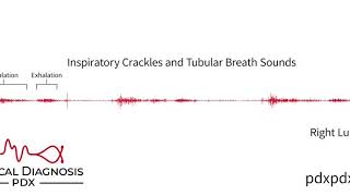 The Lung Sounds of Pneumonia [upl. by Esnohpla]