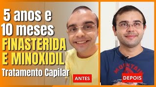 FINASTERIDA E MINOXIDIL 5 anos e 10 meses de Tratamento Capilar  Tiago Fontenele [upl. by Ewen467]