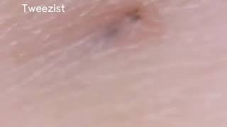 Ingrown hair removal 인그로운뽑기 [upl. by Rudman]