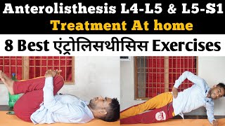 lumbar anterolisthesis l4 l5 lumbar spine anterolisthesis grade 1 treatment exercises l4 L5 L5 S1 [upl. by Attenauq]