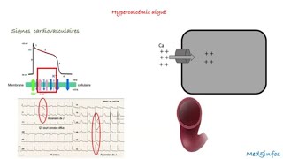 Hypercalcémie Signes cliniques [upl. by Enirak362]