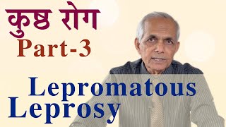 All about Leprosy  Max Hospital [upl. by Anrehs343]