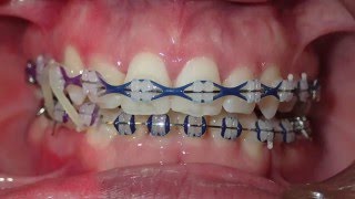 GiO Braces The Solution for Overcrowded Teeth [upl. by Asyle621]