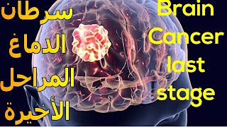 أعراض سرطان الدماغ فى مراحله الأخيرة  هل لديك إحداها ؟  Brain Cancer Symptoms [upl. by Oaoj861]