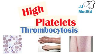 What Causes High Platelets Thrombocytosis  Approach to Causes Symptoms Treatment [upl. by Ettevets]