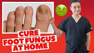 6 Effective HOME REMEDIES To CURE Toenail FUNGUS  Holistic Toenail Fungus Cures Part 2  Dr Kim [upl. by Pontone]