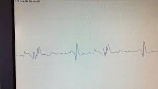 Complex repetitive discharge [upl. by Aleek]