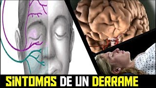 SINTOMAS DE UN DERRAME CEREBRAL FULMINANTE y COMO PREVENIRLO [upl. by Orms689]