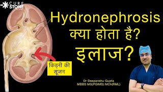 Hydronephrosis Treatment in Hindi क्या होता है kidney की सूज़न HYDRONEPHROSIS Dr Deepanshu Gupta [upl. by Ainosal569]