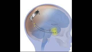 SickKids implants the first Responsive Neurostimulation Device in Canada [upl. by Zimmerman378]