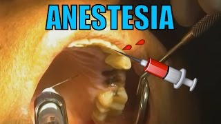 ANESTESIA DENTAL HD [upl. by Adiari]