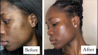 Clear Skin In 3 Months On Low Dose Accutane  What You Should Know  Helen Suah  acne [upl. by Moazami]