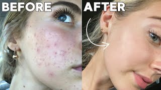 How I Cleared My Skin In 8 Weeks naturally [upl. by Nauqed]