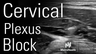 Cervical Plexus Block [upl. by Eilyw378]