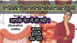 Ulcerative colitis  ulcerative colitis treatment in hindi medicine treatment viral [upl. by Gruver]