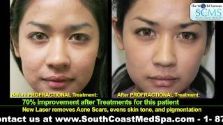 Acne Scar Removal Results [upl. by Peterus]