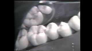 688 Class II Mesio Occlusal Cavity Preparation for Amalgam [upl. by Etteniotna]