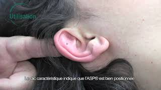 Aiguille SemiPermanente ASP® Sedatelec [upl. by Peper]