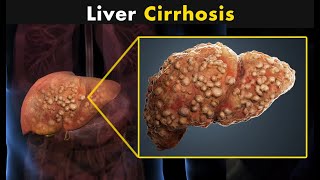 What Happens In Liver Cirrhosis  Symptoms Causes And Treatment [upl. by Aselehc]