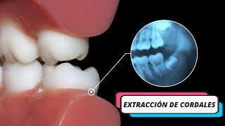 Cirujana especialista Extracción Cordales  Maxilofacial ¿En qué casos se requiere esta cirugía [upl. by Nnaecyoj]