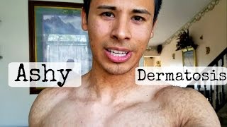 Whats on my Neck Rash Ashy dermatosis [upl. by Moersch]