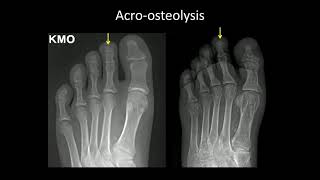 Imaging of Renal osteodystrophy [upl. by Seidnac331]