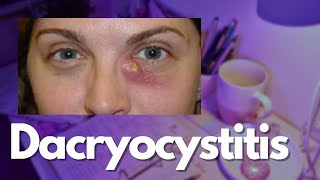 Dacryocystitis  Ophthalmology Notes [upl. by Una]