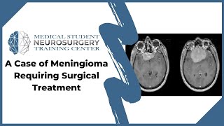 A Case of Meningioma Requiring Surgical Treatment [upl. by Aneekal]