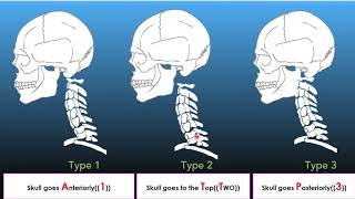 Atlanto occipital dislocation lecture [upl. by Iinden]