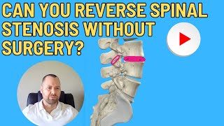 Can you reverse spinal stenosis without surgery [upl. by Ribble]