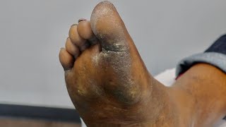 SO SATISFYING 7 mins Followup coming Look at the heel amp its dead skin Cracked heel treatment [upl. by Adele]