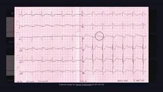 First Degree Atrioventricular Block ECG [upl. by Nwahsar]