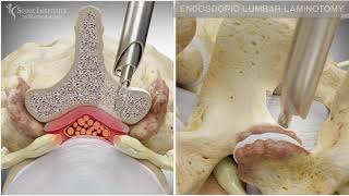 Endoscopic Lumbar Laminotomy  Spine Institute of North America [upl. by Anerdna]