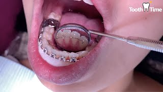 How do they put a permanent retainer on  Fixed Lower Retainer  Tooth Time Dentist New Braunfels [upl. by Selim216]