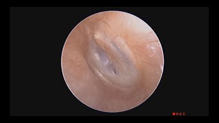 Is There A Small Eardrum Perforation [upl. by Amron]