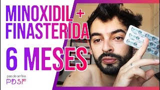 FINASTERIDA E MINOXIDIL  6 MESES DE TRATAMENTO CAPILAR [upl. by Sklar]