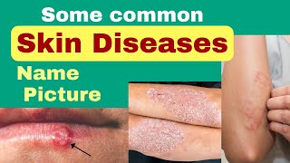 Skin diseases name and picture  skin diseases picture with name  skin problem [upl. by Viglione331]