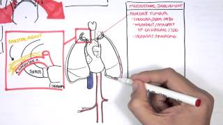 Lung Carcinoma Lung cancer [upl. by Ahsatel]