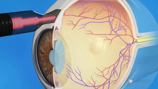 CPC for Glaucoma Treatment [upl. by Drusi251]