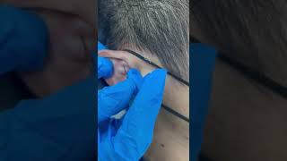 Right earlobe cyst  yellowish fluid [upl. by Jerrold]