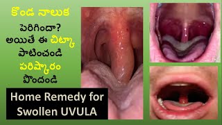 కొండ నాలుక పెరిగిందా  Swollen Uvula  Home remedy  konda naluka infection  Uvulitis Roopavenkat [upl. by Magbie691]