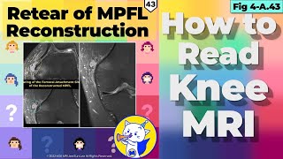 Fig 4A43 Retear of MPFL Reconstruction [upl. by Proctor]