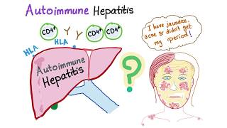 Autoimmune Hepatitis Lupoid hepatitis [upl. by Drislane]