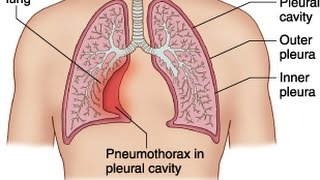 Pneumothorax [upl. by Ias]